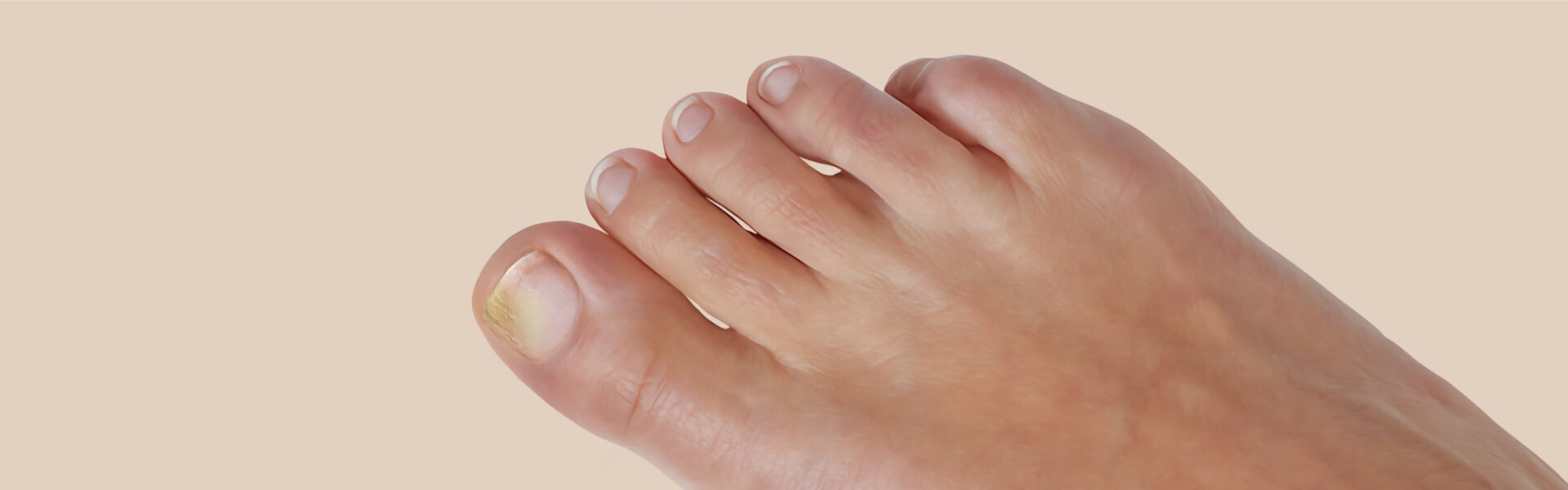 How do you get a fungal infection under the nail?